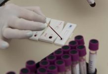 Número de infectados pelo vírus do HIV cai 35% em Blumenau teste-hiv-blumenau